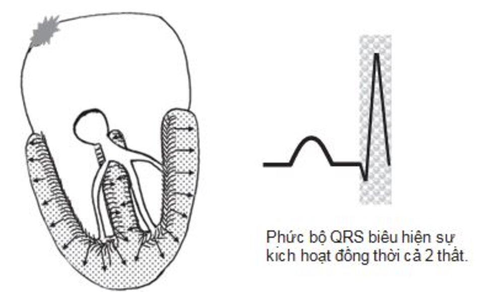 Hình 2.4: Sự kích hoạt tâm thất - Phức bộ QRS. Sự kích hoạt tâm thất được đại diện bởi một phức bộ QRS trên ECG. Vì các sợi Purkinje nằm ở nội tâm mạc, nên nội tâm mạc sẽ được kích hoạt đầu tiên và xung điện truyền từ nội tâm mạc đến thượng tâm mạc hướng ra ngoài. Các mũi tên biểu thị hướng kích hoạt.