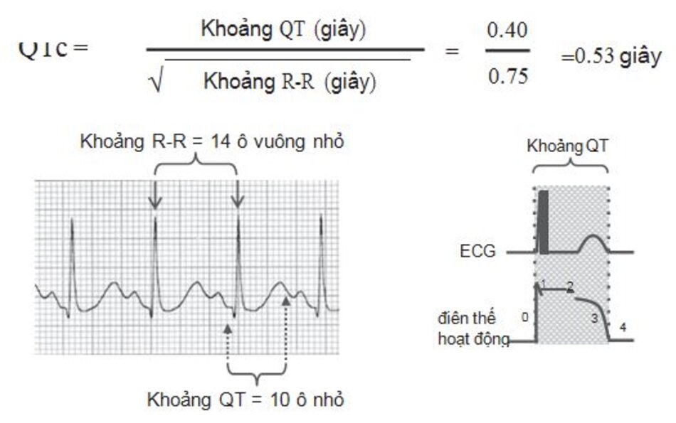 Hình 2.9: Cách tính QTc. Nếu không có máy tính, QTc có thể được tính bằng cách sử dụng bảng 2.1. Khoảng R-R trước đó cần phải đo bởi vì khoảng QT phụ thuộc vào khoảng R-R trước nó. Trong hình này, khoảng QT (10 ô nhỏ) dài hơn 1/2 khoảng R-R trước đó (14 ô vuông nhỏ), do đó QTc có lẽ là không bình thường và nên được tính như đã mô tả ở trên. Hình bên phải là lời nhắc nhở rằng khoảng QT bằng tổng thời gian của điện thế hoạt động (Pha 0 đến pha 3).