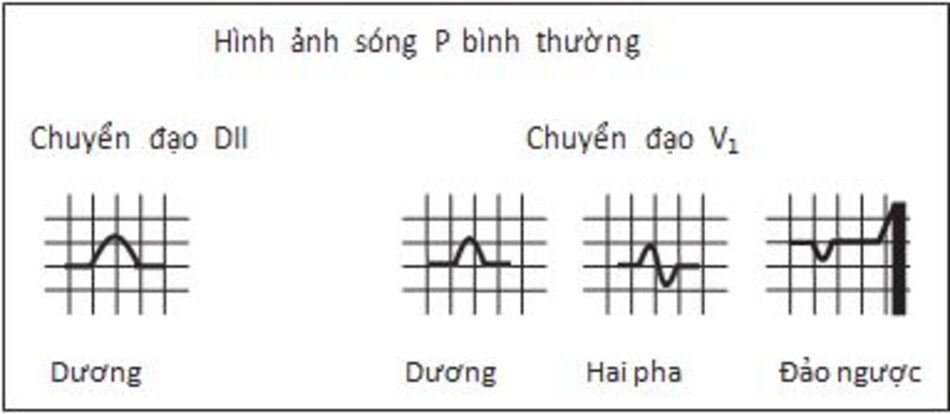 Hình 7.1: Sóng P bình thường. Sóng P tròn đều và mềm mại, dương ở các chuyển đạo DI, DII, và aVF. Chiều cao ≤ 2.5 mm và chiều rộng ≤ 2.5 mm. Ở V1, sóng P bình thường có thể có dương, hai pha hoặc đảo ngược.