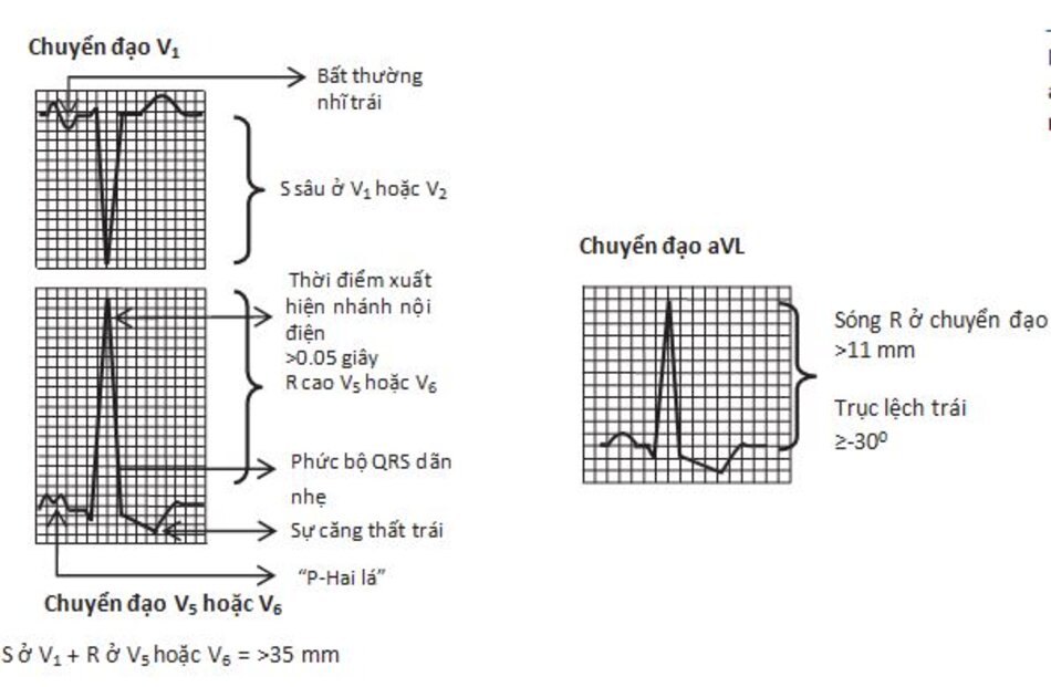 Hình 7.11: Phì đại thất trái: Điện tâm đồ 12 chuyển đạo biểu hiện tình trạng phì đại thất trái. Sóng P ở V1 sây 1 mm và rộng 1 mm do nhĩ trái lớn. Điện thế của phức bộ QRS tăng kèm S sâu ở chuyển đạo V1 và sóng R cao ở V5 và V6. ST chênh xuống với sóng T đảo ngược các chuyển đạo có R cao (Sự căng thất trái).