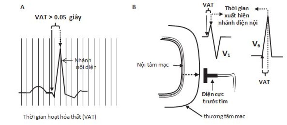 Hình 7.13: Thời gian nhánh nội điện. Thời gian hoạt hóa thất (VAT) được đo từ điểm bắt đầu phức bộ QRS đến đỉnh của sóng R. Thời gian nhánh nội điện được biểu hiện bởi sự đi xuống đột ngột của sóng R hướng về đường đẳng điện(A). Khi có phì đại thất trái, thời gian xuất hiện nhánh nội điện muộn hơn (đường nét đứt ở A và B) ở chuyển đạo V5 hoặc V6. Khi có phì đại thất phải thời gian xuất hiện nhánh nội điện sẽ muộn hơn ở các chuyển đạo V1 hoặc V2.