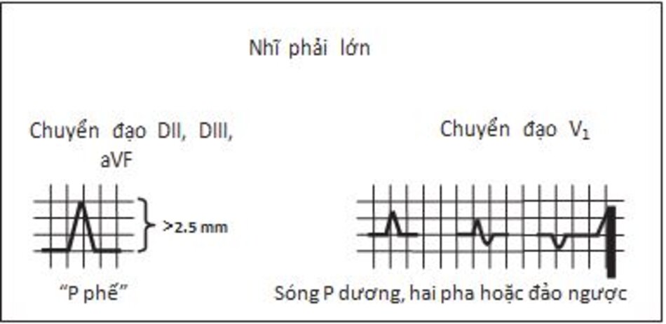 Hình 7.2: Nhĩ phải lớn. Trong trường hợp nhĩ phải lớn, sóng P chiều rộng ≤ 2.5 mm. Ở V1, sóng P bình thường có thể có dương, hai pha hoặc đảo ngược sẽ nhọn và cao với biên độ > 2.5 mm ở chuyển đạo DII, DIII, hoặc aVF. Những sự thay đổi ở V1 thường ít rõ ràng, mặc dù chiều đi lên thường dốc hơn. Sóng P không bị dãn rộng.