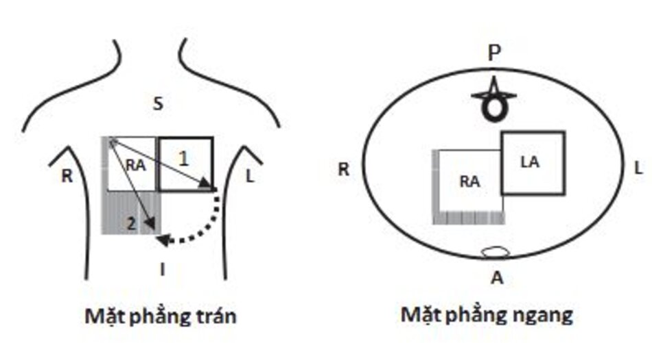 Hình 7.3: Nhĩ phải lớn. Ở mặt phẳng trán, nhĩ phải sẽ lớn xuống dưới và sang phải khiến trục sóng P chuyển sang bên phải (từ mũi tên 1 sang mũi tên 2). Ở mặt phẳng ngang, nhĩ phải lớn hơi hướng ra trước, điều này có thể làm sóng P dốc nhẹ ở chuyển đạo V1. Phần bóng biểu thị cho sự thay đổi xảy ra khi nhĩ phải lớn. S, superior (trên); I, inferior (dưới); R, right (phải); L, left (trái); A, anterior (trước); P, posterior (sau); RA, right atrium (nhĩ phải); LA, left atrium (nhĩ trái).