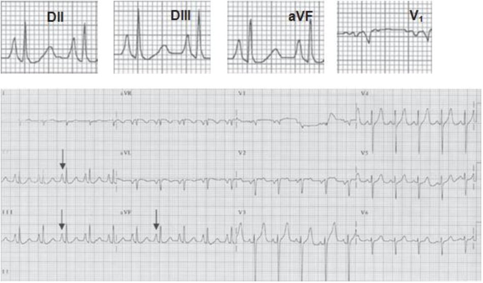 Hình 7.4: Nhĩ phải lớn. ECG 12 chuyển đạo biểu hiện nhĩ phải lớn. Sóng P cao và nhọn, còn được gọi là "P phế", được nhìn thấy ở các chuyển đạo DII, DIII và aVF (mũi tên). Chú ý rằng sóng P ở chuyển đạo DIII cao hơn ở chuyển đạo DI. Chuyển đạo DII, DIII, aVF và V1 được phóng to để quan sát biểu hiện của sóng P bất thường. Bệnh nhân mắc COPD.