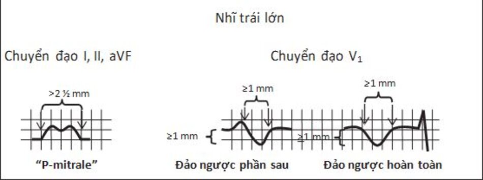 Hình 7.5: Nhĩ trái lớn. Sóng P bị kéo dài ra >2.5 mm ở chuyển đạo I, II, aVF, với dạng chẻ đôi hoặc dạng chữ "M". Kiểu này của sóng P được gọi là "P-hai lá". Ở chuyển đạo V1, sóng P bị đảo ngược hoàn toàn hoặc có thể hai pha. Phần đảo ngược rộng và sâu, ≥1 mm chiều rộng và ≥1 mm chiều sâu.