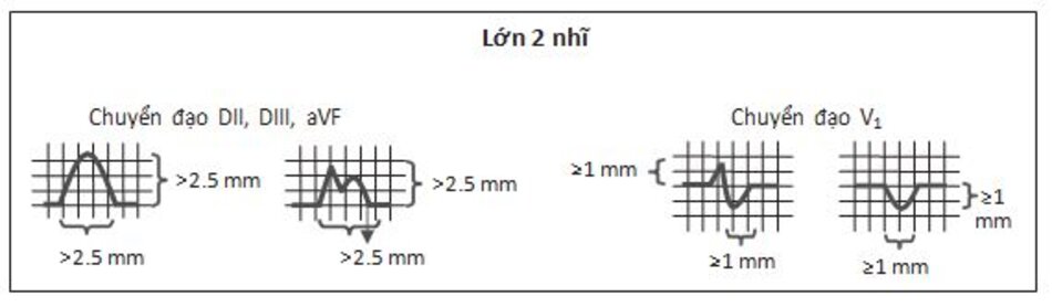 Hình 7.8: Lớn 2 nhĩ. Lớn 2 nhĩ được đặc trưng bởi sóng P cao và rộng với chiều cao >2.5 mm và kéo dài >2.5 mm. Ở chuyển đạo V1, sóng P có dạng 2 pha hoặc đảo ngược. Phần đầu có thể nhọn do nhĩ phải lớn. Phần đảo ngược thường rộng và sâu với chiều rộng >1 mm và chiều sâu > 1 mm vì nhĩ trái lớn.