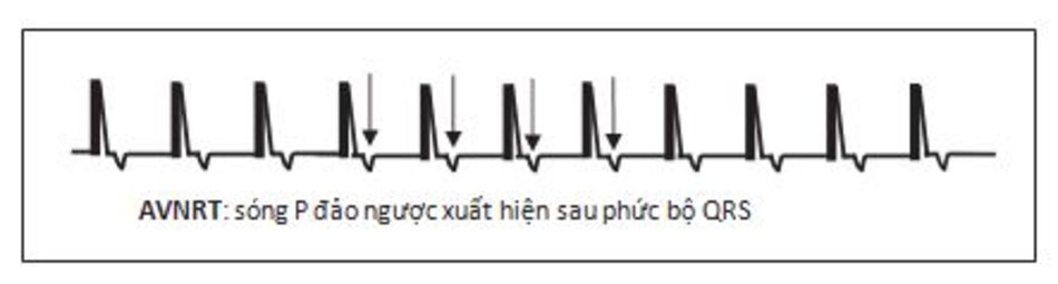 Hình 16.11: Các biểu hiện khác của nhịp nhanh vào lại nút nhĩ thất (AVNRT). Sóng P đảo ngược (mũi tên) xuất hiện ngay sau phức bộ QRS và làm thay đổi hình dạng của đoạn ST, sóng T của phức bộ đi trước. Biểu hiện này mặc dù có thể gặp ở AVNRT nhưng nó xuất hiện phổ biến hơn trong trường hợp nhịp nhanh vào lại nhĩ thất (AVRT).