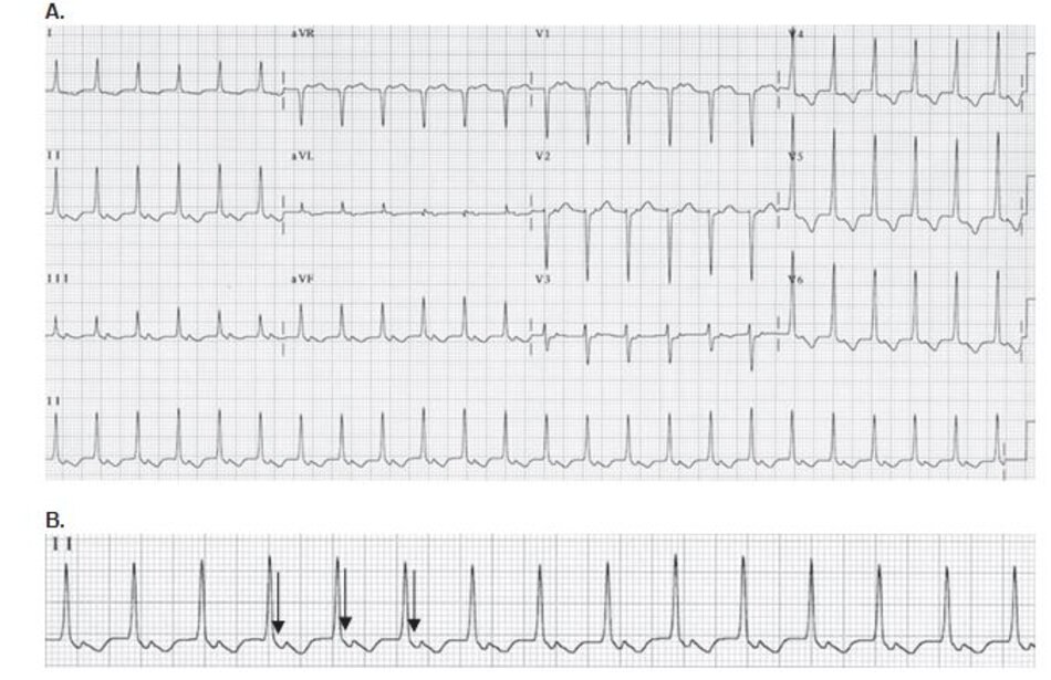 Hình 16.12: Hình ảnh ECG cho thấy những biểu hiện khác của nhịp nhanh vào lại nút nhĩ thất (AVNRT). Hình ảnh ECG 12 chuyển đạo (A) và hình ảnh ECG trên chuyển đạo DII ở cùng một bệnh nhân (B) cho thấy sóng P đảo ngược xuất hiện cách xa phức bộ QRS (mũi tên). Mặc dù những biểu hiện này thường gặp hơn trong trường hợp nhịp nhanh vào lại nhĩ thất (AVRT), thăm dò điện sinh lý ở bệnh nhân này cho phép xác định đó là AVNRT và có thê đốt thành công đường dẫn truyền chậm.
