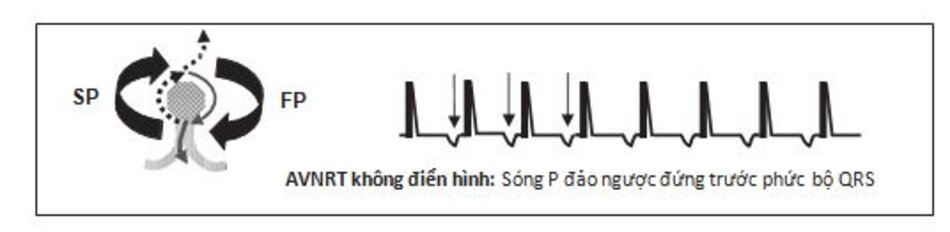 Hình 16.13: Nhịp nhanh vào lại nút nhĩ thất (AVNRT) không điển hình. Sóng P đảo ngược (mũi tên) xuất hiện phía trước phức bộ QRS với khoảng R-P dài hơn khoảng PR. Xung động được dẫn truyền ngược lên theo con đường chậm và dẫn truyền từ trên xuống thông qua con đường nhanh.