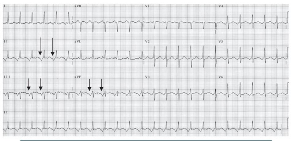 Hình 16.14: Hình ảnh ECG nhịp nhanh vào lại nút nhĩ thất (AVNRT). Sóng P đảo ngược nằm phía trước phức bộ QRS ở các chuyển đạo DII, DIII, aVF (mũi tên). Mặc dù điều này cũng thường thấy trên các thể SVT khác như nhịp nhanh nhĩ đơn ổ hay nhịp nhanh bộ nối, hình ảnh ECG trên cũng có thể gặp ở những bệnh nhân mắc AVNRT không điển hình.