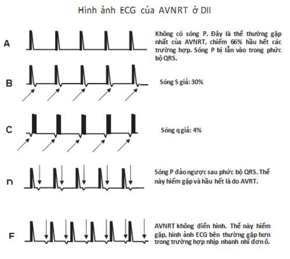 Hình 16.15: Tóm tắt các thể khác nhau của nhịp nhanh vào lại nút nhĩ thất (AVNRT). (A-E) Hình ảnh ECG khác nhau của các thể AVNRT ở chuyển đạo DII, hình ảnh A mũi tên chỉ sóng P đảo ngược.