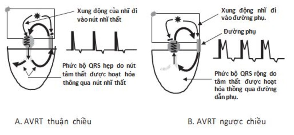 Hình 16.16: Nhịp nhanh vào lại nhĩ thất (AVRT) thuận chiều và ngược chiều: AVRT thuận chiều (A), phức bộ QRS hẹp vì tâm thất được hoạt hóa thông qua hệ thống dẫn truyền nhĩ thất bình thường. Đối với AVRT ngược chiều (B), phức bộ QRS rộng vì tâm thất được hoạt hóa thông qua đường phụ.