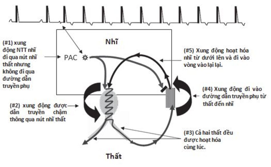 Hình 16.17: Cơ chế của nhịp nhanh vào lại nhĩ thất (AVRT) với phức bộ QRS hẹp. Hình bên cho thấy xung động ngoại tâm thu nhĩ gây nên AVRT với phức bộ QRS hẹp như thế nào. Xung động ngoại tâm thu đi đến đường dẫn truyền phụ nhưng không thể đi qua được do nó vẫn còn trơ vì có thời gian trơ dài. Trong lúc đó, xung động này lại có thể đi qua nút nhĩ thất (thời gian trơ ngắn hơn) tạo nên AVRT với phức bộ QRS hẹp