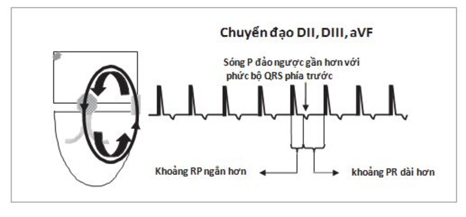 Hình 16.18: Nhịp nhanh vào lại nhĩ thất (AVRT) điển hình. Trong AVRT, sóng P đảo ngược xuất hiện ngay phía sau phức bộ QRS với khoảng RP ngắn hơn khoảng PR. Đây là thể điển hình hay phổ biến của AVRT,