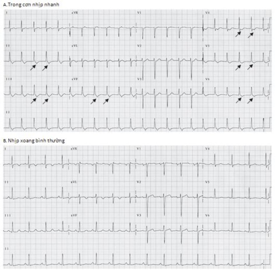 Hình 16.19: Hình ảnh ECG của nhịp nhanh vào lại nhĩ thất (AVRT). (A) Nhịp nhanh phức bộ QRS hẹp với sóng P đảo ngược ở các chuyển đạo DII, DIII, aVF và V4 đến V6 (mũi tên). Sóng P đảo ngược xuất hiện ngay phía sau phức bộ QRS và làm thay đổi đoạn ST hay sóng T của phức bộ trước với khoảng R-P ngắn hơn khoảng P-R. (B) ECG sau khi chuyển về nhịp xoang trên cùng một bệnh nhân. Sóng P đảo ngược không còn xuất hiện.