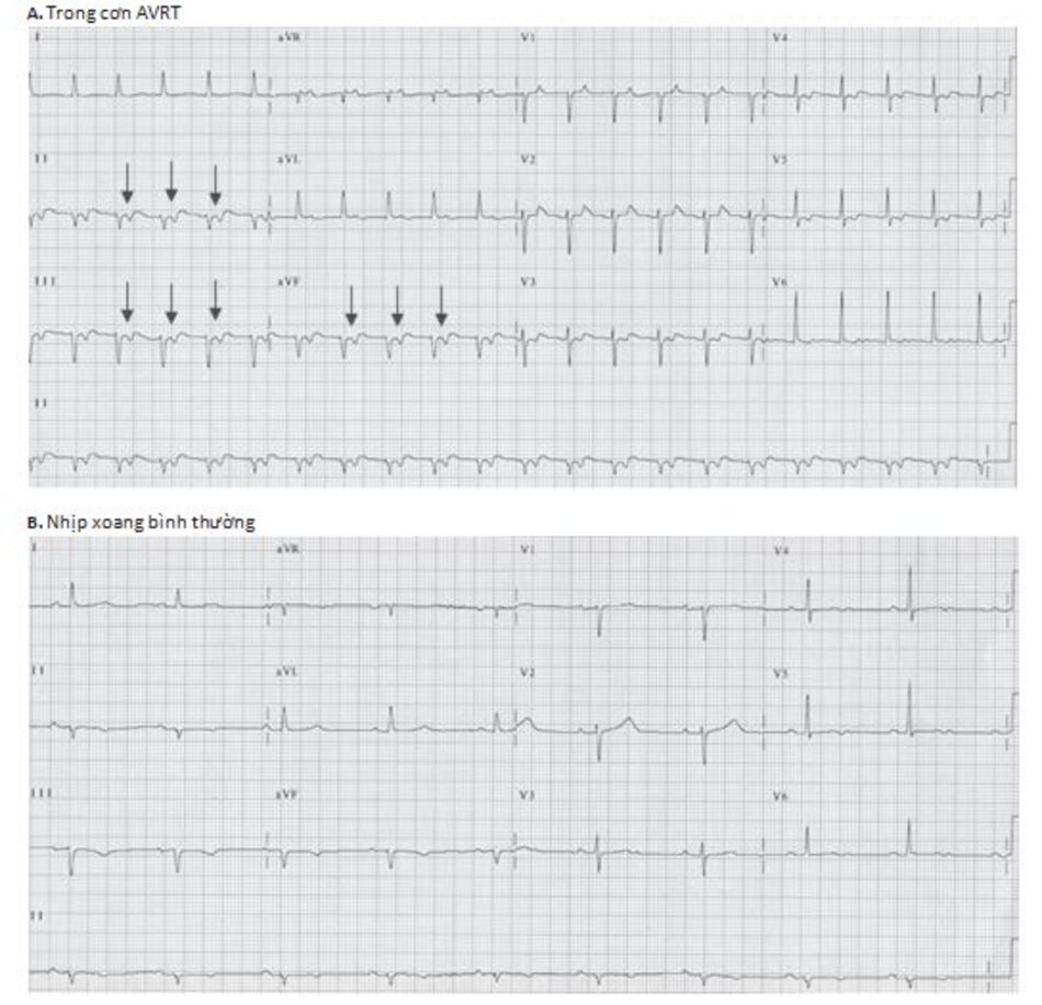 Hình 16.20: Sóng P đảo ngược có thể bị nhầm lẫn với sóng T âm trong nhịp nhanh vào lại nhĩ thất (AVRT). (A) Hình ảnh ECG trong cơn nhịp nhanh. Sóng P đảo ngược xuất hiện ngay phía sau phức bộ QRS với khoảng RP ngắn hơn khoảng PR. Đây là thể phổ biến nhất của AVRT. Sóng P đảo ngược có thể bị nhầm lẫn với sóng T âm ở các chuyển đạo DII, DIII, aVF (mũi tên). (B) hình ảnh ECG của cùng một bệnh nhân sau khi chuyển về nhịp xoang bình thường. Sóng P đảo ngược không còn được nhìn thấy.