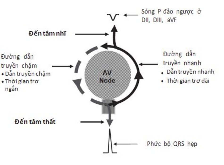 Hình 16.2. Sơ đồ biển thị vòng vào lại điện học của nhịp nhanh vào lại nút nhĩ thất (AVNRT). Hai đường dẫn truyền tách biệt hiện diện xung quanh nút nhĩ thất, đường dẫn truyền chậm (đường nét đứt) dẫn truyền xung động chậm và có thời gian trơ ngắn hơn. Đường dẫn truyền nhanh (đường nét liền) dãn truyền xung động nhanh và có thời gian trơ dài hơn. Xung động chạy quanh nút nhĩ thất lặp lại nhờ 2 đường dẫn truyền tách biệt này, tạo nên nhịp nhanh do vòng vào lại gọi là AVNRT.