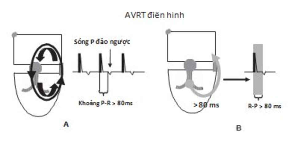 Hình 16.21: Khoảng R-P trong nhịp nhanh vào lại nhĩ thất điển hình (AVRT). Trong AVRT điển hình, khoảng R-P (đo được từ điểm khởi phát của phức bộ QRS đến điểm khởi phát của sóng P đảo ngược) đo được ≥ 80 ms. Đây là khoảng thời gian cần cho xung động dẫn truyền ngược chiều từ thất tới nhĩ thông qua đường dẫn truyền phụ. Độ dài của mũi tên trong hình (B) chỉ ra khoảng R-P.