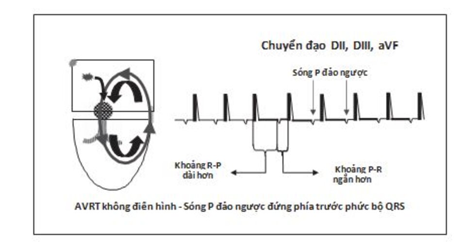 Hình 16.23: Nhịp nhanh vào lại nhĩ thất (AVRT) không điển hình. Trong AVRT không điển hình, sóng P đảo ngược xuất hiện phía trước phức bộ QRS với khoảng R-P dài hơn khoảng P-R. AVRT không điển hình thường do đường phụ dẫn truyền chậm, do vậy làm cho khoảng R-P dài ra.