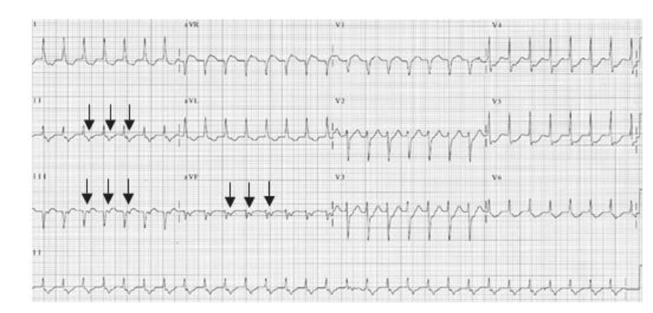 Hình 16.24: Nhịp nhanh vào lại nhĩ thất điển hình. Hình ảnh ECG của AVRT điển hình. Sóng P đảo ngược xuất hiện ở các chuyển đạo DII, DIII, aVF (mũi tên) với khoảng R-P đo được 80 ms.Khoảng RP ngắn hơn khoảng PR.