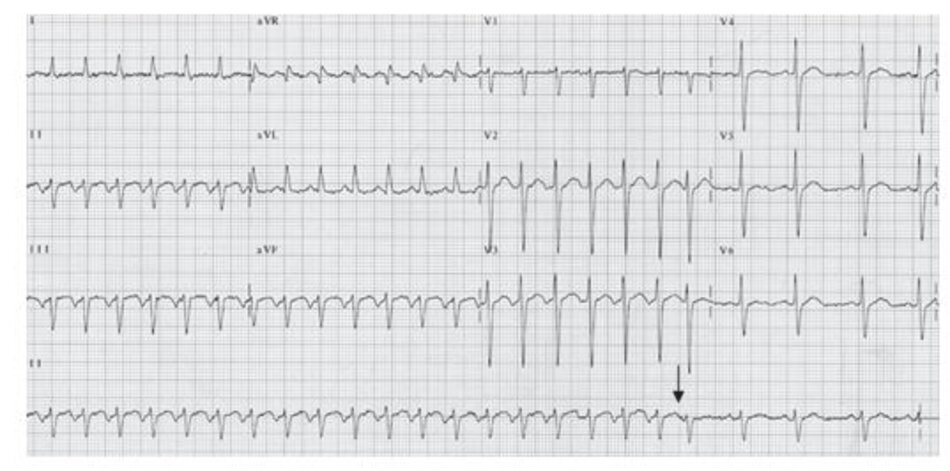 Hình 16.25: Nhịp nhanh vào lại nhĩ thất không điển hình. Trong AVRT không điển hình, sóng P đảo ngược đứng phía trước phức bộ QRS (khoảng RP dài hơn khoảng PR) do sự hiện diện của đường dẫn truyền phụ chậm. Cơn nhịp nhanh trên thất kết thúc bởi một ngoại tâm thu nhĩ đến đúng thời điểm (mũi tên).