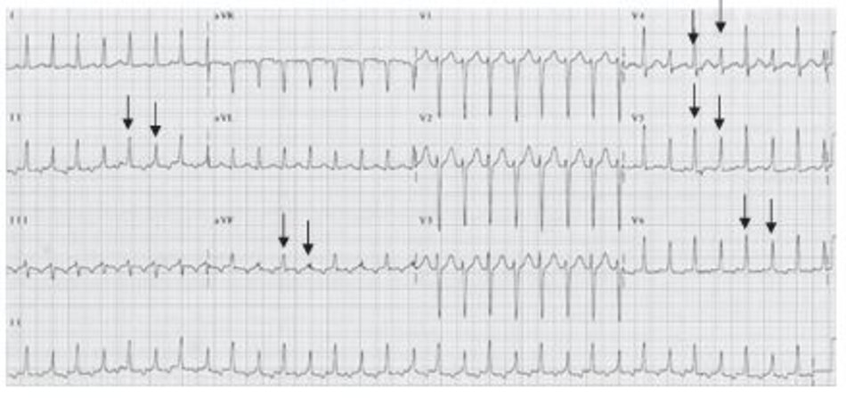 Hình 16.26: Luân phiên điện học. Trong luân phiên điện học, phức bộ QRS cao hơn xen kẽ với phức bộ QRS thấp hơn với sự chênh lệch độ cao ít nhất là 1mm. Mũi tên chỉ phức bộ QRS cao và thấp xen kẽ với nhau. So le điện học thường gặp trong AVRT hơn là các type khác của nhịp nhanh trên thất (SVT) do nhịp thất của AVRT nhìn chung nhanh hơn khi so sánh với các loại SVT khác. 