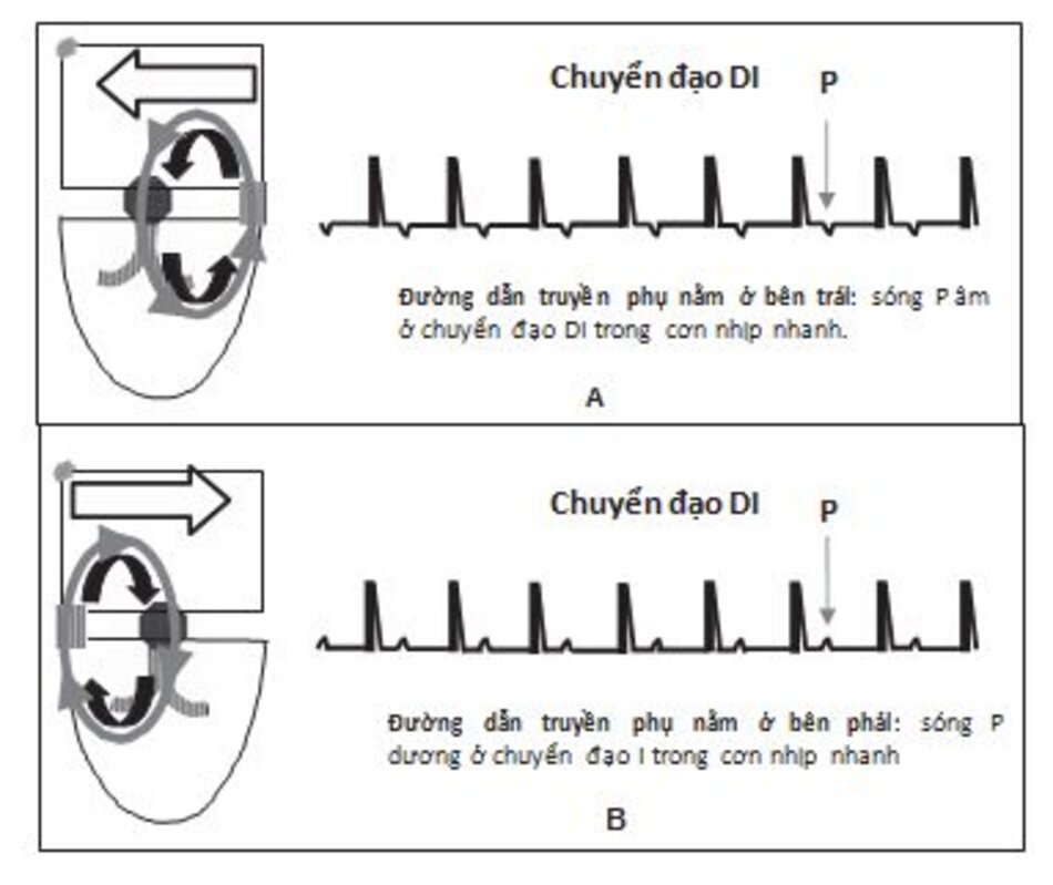 Hình 16.27: Định khu đường dẫn truyền phụ. Nếu sóng P âm ở chuyển đạo I trong cơn nhịp nhanh (A), đường dẫn truyền phụ nằm ở bên trái. Nếu sóng P dương ở chuyển đạo I trong cơn nhịp nhanh (B), đường dẫn truyền phụ nằm ở bên phải. Mũi tên chỉ hướng hoạt hóa tâm nhĩ.