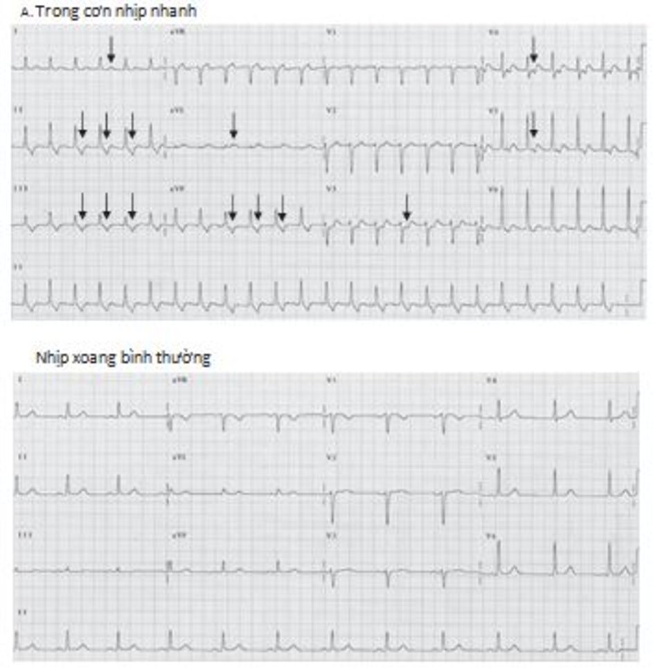 Hình 16.28: Nhịp nhanh vào lại nhĩ thất (AVRT). (A) Hình ảnh ECG trong cơn nhịp nhanh. Sóng P âm ở các chuyển đạo DII, DIII, aVF và dương ở chuyển đạo DI, aVL (mũi tên).Sóng P âm cũng hiễn diện từ V3 đến V5. Sự hiện diện của sóng P dương ở chuyển đạo DI và aVL trong cơn nhịp nhanh cho thấy hướng hoạt hóa tâm nhĩ sẽ đi từ phải sang trái, phù hợp với đường dẫn truyền phụ nằm bên phải. Lưu ý, khi chuyển về nhịp xoang (B), không có bằng chứng của hội chứng tiền kích thích xuất hiện. Loại AVRT này liên quan đến đường dẫn truyền phụ ẩn giấu.