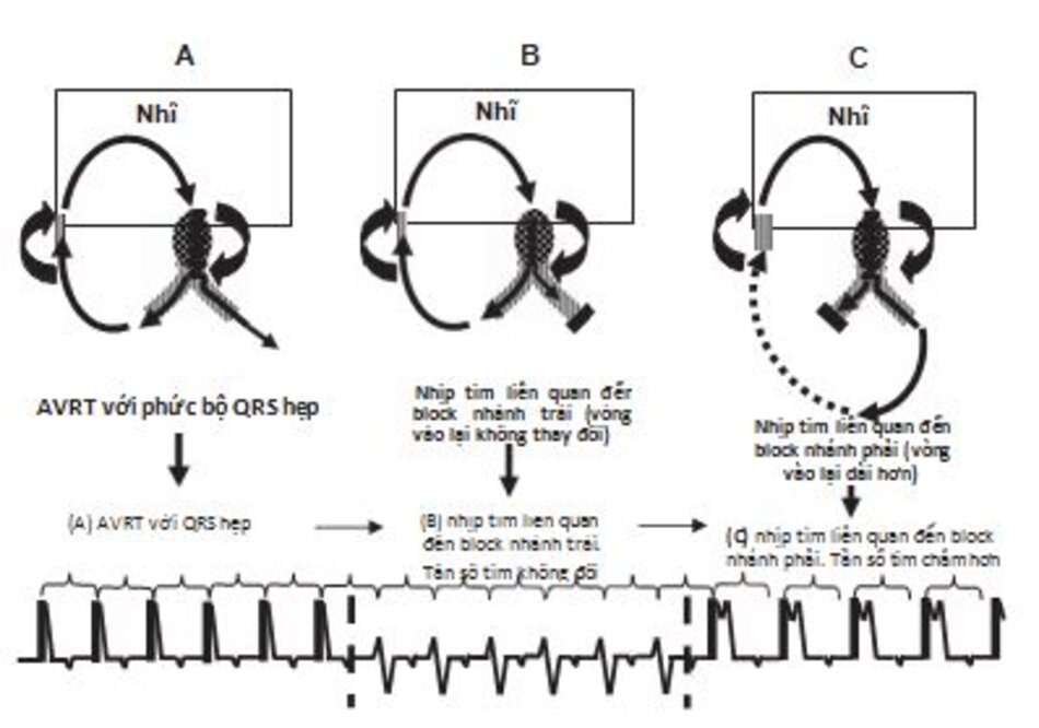Hình 16.29: Khu trú đường dẫn truyền phụ. Biểu đồ trên giải thích vì sao khi block nhánh xuất hiện sẽ làm chậm lại nhịp tim trong cơn AVRT nếu đường dẫn truyền phụ nằm cùng bên với nhánh bị block. (A) AVRT với phức bộ QRS hẹp với đường dẫn truyền phụ nằm bên phải. (B) Nếu block nhánh trái xuất hiện trong cơn nhịp nhanh, vòng vào lại sẽ không bị ảnh hưởng bởi block nhánh và tần số tim không thay đổi. (C) nếu block nhánh phải xuất hiện trong cơn nhịp nhanh, vòng vào lại sẽ bị thay đổi do thất phải và đường dẫn truyền phụ sẽ được hoạt hóa từ thất trái, do con đường dẫn truyền xung động dài hơn nên trong trường hợp này tần số tim trong cơn AVRT sẽ chậm lại.