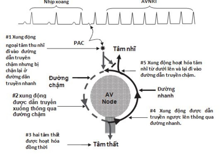 Hình 16.3: Cơ chế của nhịp nhanh vào lại nút nhĩ thất. Ngoại tâm thu nhĩ (PAC) được dẫn truyền xuống thông qua đường dẫn truyền chậm nhưng bị chặn lại ở đường dẫn truyền nhanh. Xung động hoạt hóa 2 tâm thất và cùng thời điểm đó, nó được dẫn truyền theo đường nhanh để hoạt hóa tâm nhĩ tạo nên vòng vào lại.