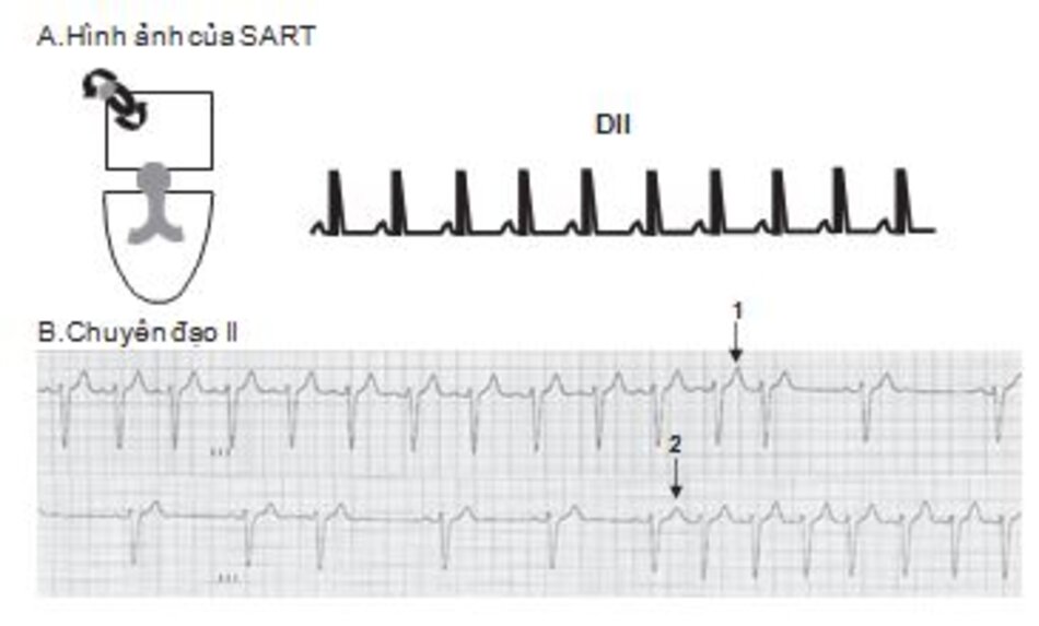 Hình 16.30: Nhịp nhanh vào lại xoang nhĩ (SART). (A) Hình ảnh của SART. Do nút xoang là một thành phần của vòng vào lại, sóng P giống như trong nhịp nhanh xoang và dương ở các chuyển đạo DII, DIII, aVF. (B) Đạo trình chuyển đạo II ở bệnh nhân SART.SART có thể kết thúc (mũi tên 1) và khởi phát (mũi tên 2) bằng một ngoại tâm thu nhĩ và có tính chất kịch phát.