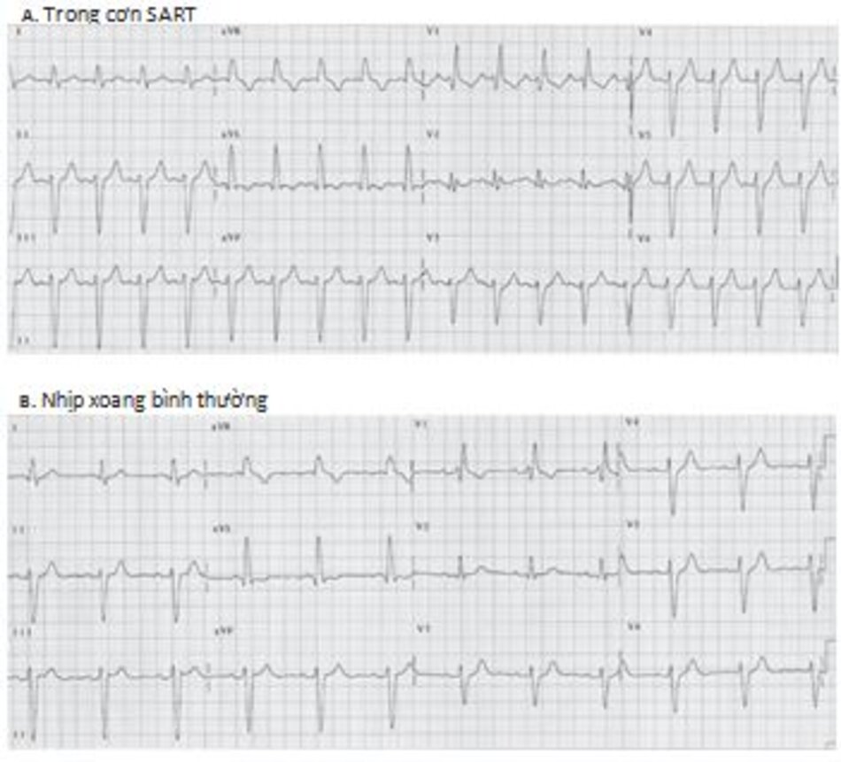 Hình 16.31: Hình ảnh ECG của nhịp nhanh vào lại xoang nhĩ (SART). (A,B) là hình ảnh ECG của cùng một bệnh nhân. (A) hình ảnh ECG trong cơn SART. (B) hình ảnh ECG sau khi chuyển SART về nhịp xoang bình thường. Lưu ý, sóng P nhìn thấy trong cơn SART giống y hệt như trong nhịp xoang. Đa số bệnh nhân với SART rất khó chẩn đoán vì dễ nhầm lẫn với nhịp nhanh xoang.