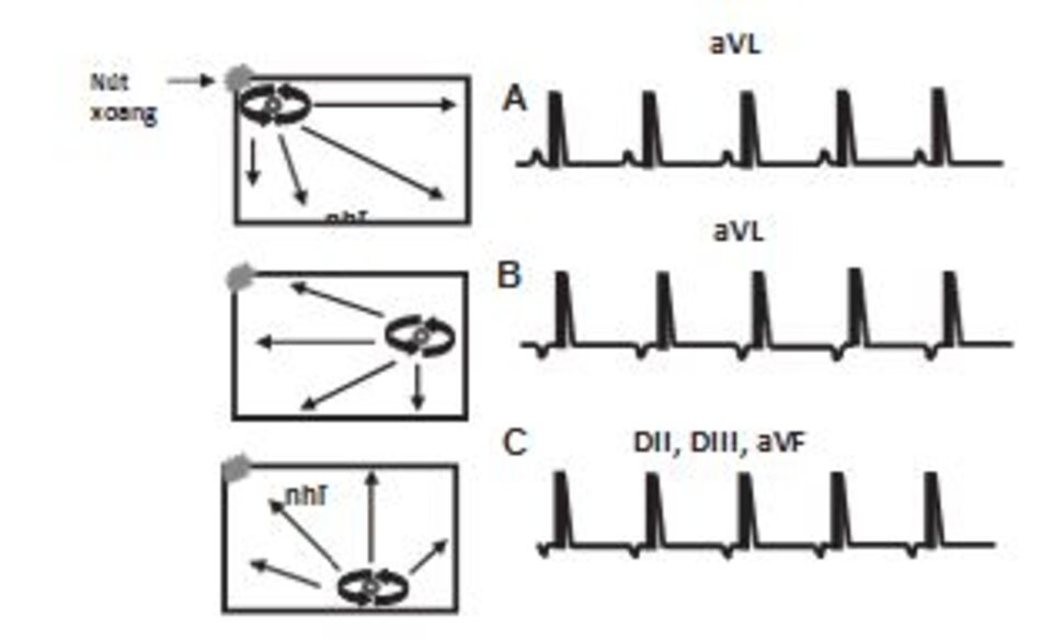 Hình 16.32: Nhịp nhanh vào lại trong nhĩ (IART). Trong IART, vòng vào lại nhỏ hiện diện ở tâm nhĩ, xung động lan truyền ra xung quanh theo vòng tròn để hoạt hóa hai nhĩ. IART do vậy là một ví dụ của nhịp nhanh nhĩ đơn ổ. Hình dạng của sóng P sẽ phụ thuộc vào vị trí khởi phát của cơn nhịp nhanh. (A) Sóng P dương hay hai pha ở chuyển đạo aVL do vòng vào lại khởi phát từ nhĩ phải gần với nút xoang. (B) sóng P âm ở chuyển đạo aVL do vòng vào lại khởi phát từ nhĩ trái. (C) sóng P âm ở các chuyển đạo DII, DIII, aVF do cơn nhịp nhanh khởi phát từ đáy của tâm nhĩ (xem Hình 13.6 và 13.7).