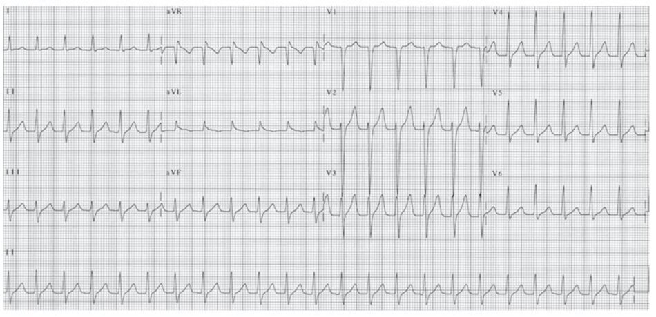 Hình 16.5: Hình ảnh ECG của nhịp nhanh vào lại nút nhĩ thất (AVNRT). "Không có sóng P", sóng P đảo được đã bị lẫn vào trong phức bộ QRS do vậy ta không thể nhìn thấy trên điện tâm đồ 12 chuyển đạo. Đây là biểu hiện thường gặp nhất của AVNRT.