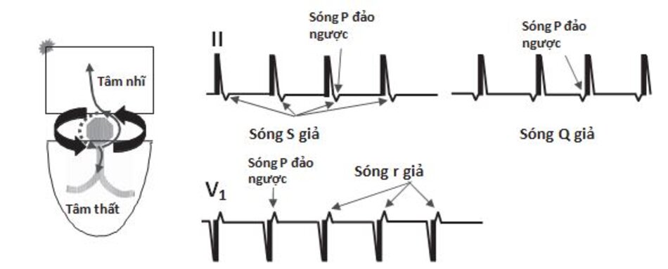 Hình 16.6: Sóng S giả và R' giả trong nhịp nhanh vào lại nút nhĩ thất (AVNRT). Trong AVNRT, sóng P đảo ngược có thể xuất hiện ở đầu hay cuối phức bộ QRS và dễ bị nhầm lẫn với sóng Q hay S ở các chuyển đạo DII, DIII, aVF hay r' ở chuyển đạo V1. Những sóng này sẽ biến mất khi chuyển từ cơn nhịp nhanh về nhịp xoang bình thường (xem Hình 16.7).