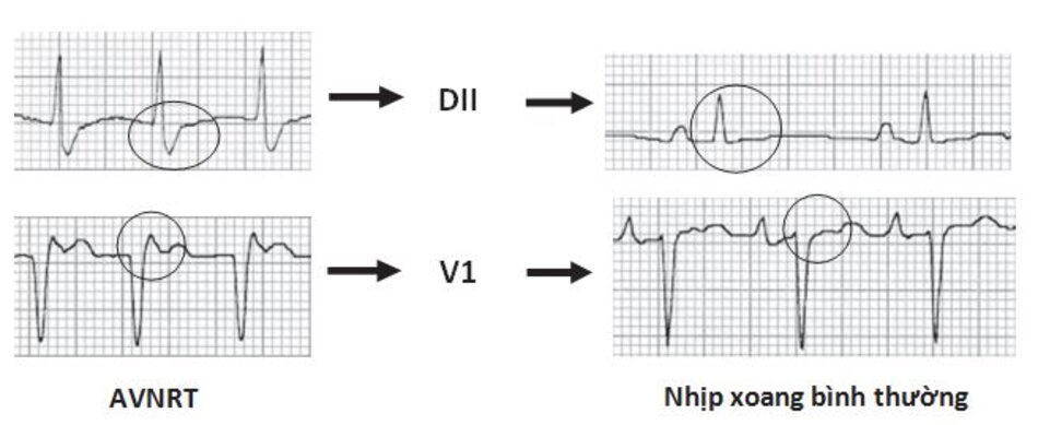 Hình 16.7: Nhịp nhanh vào lại nút nhĩ thất (AVNRT) trước và sau khi chuyển nhịp sang nhịp xoang. Lưu ý: sóng S giả ở DII và r' giả ở V1 trong cơn AVNRT sẽ mất đi sau khi chuyển sang nhịp xoang bình thường.