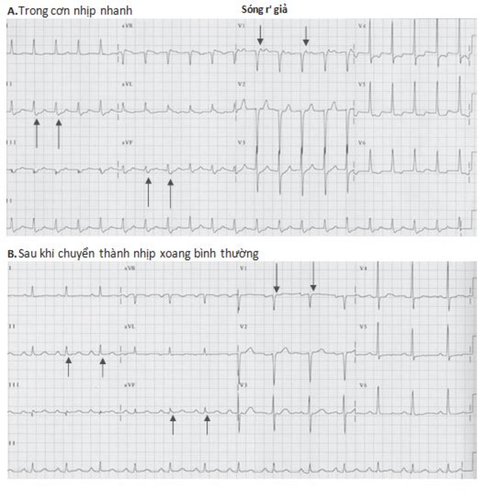 Hình 16.8: Nhịp nhanh vào lại nút nhĩ thất (AVNRT) với sóng S và R' giả. ECG trong cơn AVNRT: hình (A), lưu ý: sóng S giả ở chuyển đạo DII, aVF và r' ở V1 (mũi tên) không còn xuất hiện khi chuyển về nhịp xoang bình thường (B) 