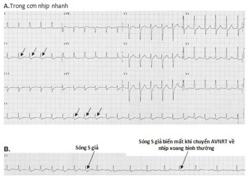 Hình 16.9: Sự chuyển nhịp tự phát từ cơn nhịp nhanh vào lại nút nhĩ thất (AVNRT) về lại nhịp xoang bình thường. (A) Hình ảnh ECG cho thấy sóng S giả ở chuyển đạo DII (mũi tên). (B) Hình ảnh ECG trên chuyển đạo DII của cùng một bệnh nhân giữa hai thời điểm: trong cơn nhịp nhanh (nửa bên trái của đạo trình) và sau quá trình tự chuyển về nhịp xoang bình thường (nửa bên phải của đạo trình). Lưu ý: Sóng S giả trong cơn AVNRT không còn xuất hiện (mũi tên)