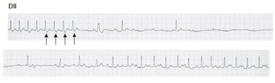 Hình 16.10: Chuyển cơn nhịp nhanh vào lại nút nhĩ thất (AVNRT) sang nhịp xoang bằng Adenosine. Adenosine là thuốc được chọn để chuyển AVNRT sang nhịp xoang. Phần đầu của đạo trình cho thấy cơn nhịp nhanh phức bộ QRS hẹp với sóng S giả (mũi tên) ở chuyển đạo DII phù hợp với AVNRT. Lưu ý sự biến mất của sóng S giả sau khi chuyển sang nhịp xoang. Cơn nhịp nhanh kết thúc tại sóng S giả (mũi tên cuối cùng) gợi ý vòng vào lại đã bị cắt đứt ở đường dẫn truyền chậm.