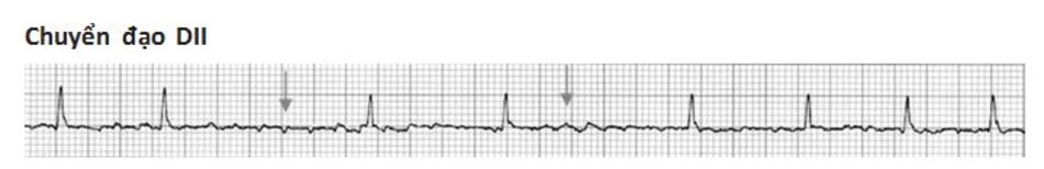 Hình 19.1: Rung nhĩ. Hình ảnh ECG của rung nhĩ. Để ý thấy các sóng rung nhĩ (mũi tên) nằm giữa các khoảng RR bất thường.