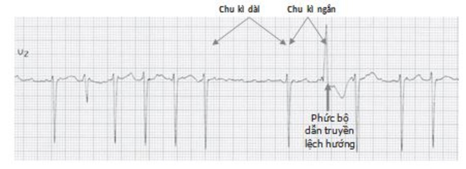 Hình 19.15: Dẫn truyền lệch hướng thất. Mũi tên hướng lên trên cho thấy hình ảnh của một dẫn truyền trên thất lệch hướng, là phức bộ QRS thứ hai sau khoảng RR dài. Phức bộ dẫn truyền lệch hướng rộng và thường có hình ảnh block nhánh phải. Phức bộ QRS rộng có thể bị chẩn đoán nhầm với ngoại tâm thu thất.