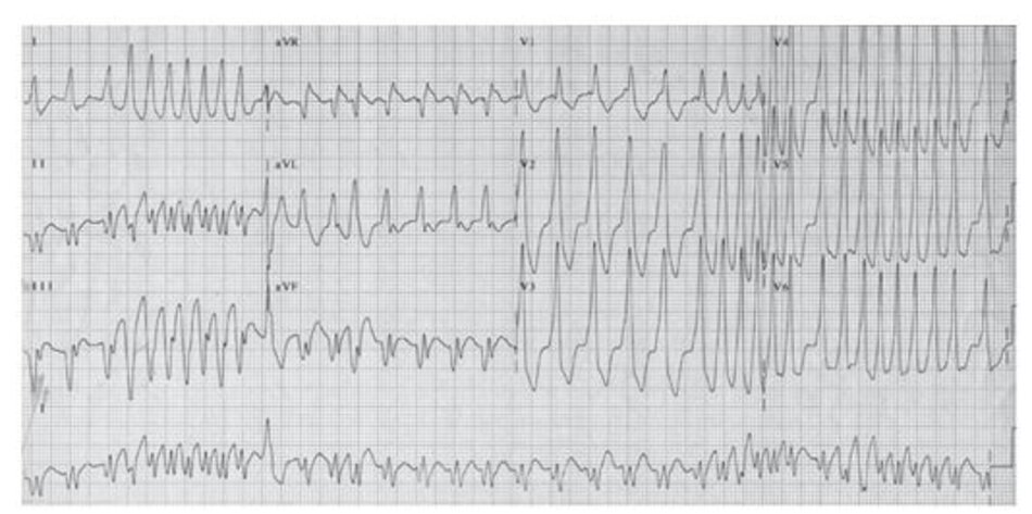 Hình 19.16: Rung nhĩ với hội chứng Wolff-Parkinson-White (WPW). Chú ý rằng các khoảng RR thay đổi bất thường với hình dạng phức bộ QRS rất kì quái vì rung nhĩ đi kèm với các nhát bóp hỗn hợp thất ở mức độ khác nhau. Rung nhĩ trên nền hội chứng WPW có thể gây rối loạn huyết động và đột tử do rung thất.