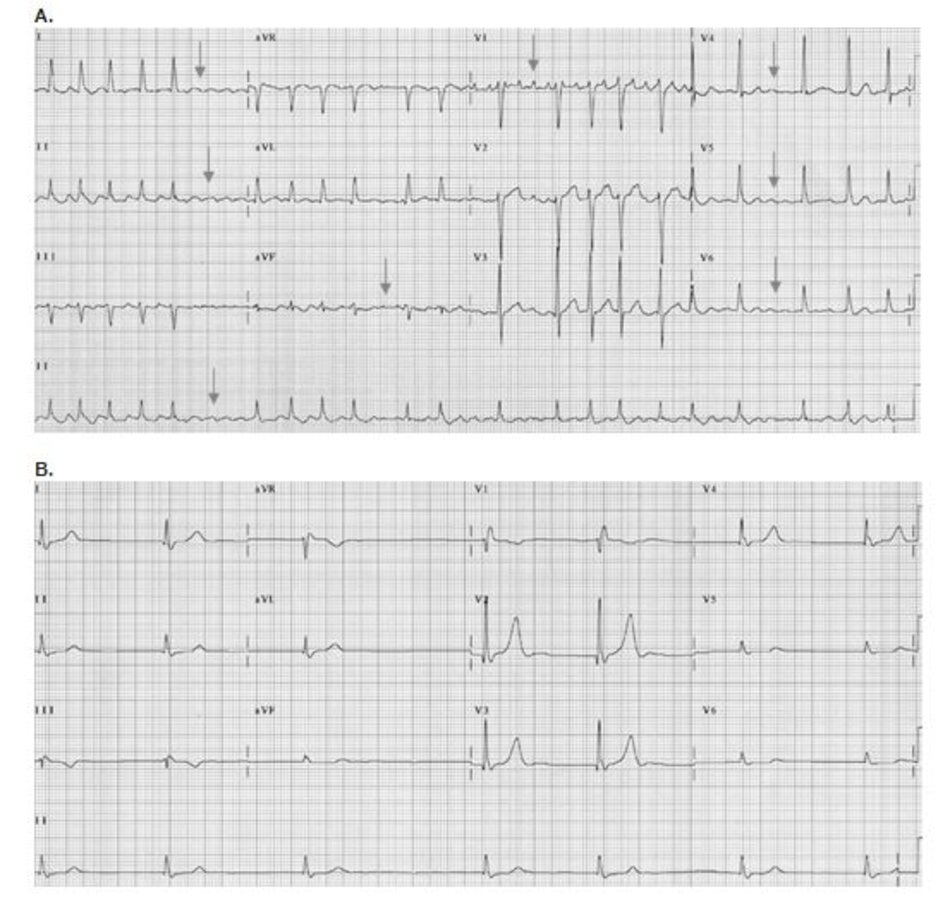 Hình 19.2: Rung nhĩ. Hai kết quả ECG. (A) Rung nhĩ với các sóng rung nhĩ ở V1 và các chuyển đạo khác được đánh dấu mũi tên. (B) ECG 12 chuyển đạo của một bệnh nhân khác cho thấy không có hình ảnh hoạt động điện của nhĩ, không xuất hiện các sóng rung nhĩ trong tất cả các chuyển đạo. Chẩn đoán rung nhĩ dựa trên các khoảng RR không đều bất thường.