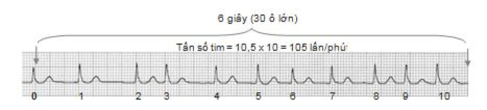 Hình 19.3: Tính tần số trong 6 giây. 30 ô lớn tương ứng với 6 giây. Trên đây là một ví dụ, có 10,5 phức bộ QRS trong khoảng thời gian 6 giây do đó tần số tim là 10,5x10 = 105 lần/phút.