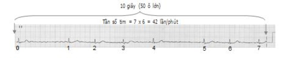 Hình 19.4: Tính tần số trong 10 giây. Khi tần số tim rất chậm, cần phải tính tần số tim trong khoảng 10 giây để tăng độ chính xác. Như ví dụ trên, có 7 phức bộ QRS trong 10 giây. Tần số tim là 7 x 6 = 42 lần/phút.