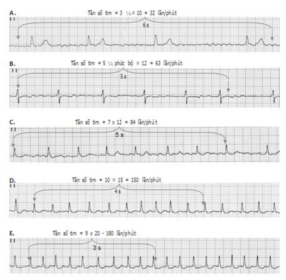 Hình 19.5: Rung nhĩ (AF). Rung nhĩ dễ dàng được nhận diện bằng các khoảng RR thay đổi bất thường và đường đẳng điện nhấp nhô. Khi tần số thất trở nên nhanh hơn (A-E), khoảng RR trở nên ít bất thường hơn. Tần số thất ở hình (E) rất nhanh nên khoảng RR nhìn có vẻ đều nhau và có thể bị nhầm với nhịp nhanh trên thất.