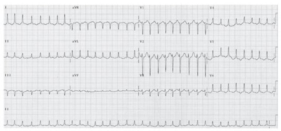 Hình 19.8: Rung nhĩ đáp ứng thất nhanh. Khi tần số thất trở nên rất nhanh, sự bất thường của các khoảng RR trở nên khó phát hiện. Rung nhĩ dễ bị chẩn đoán nhầm với nhịp nhanh trên thất, đặc biệt khi sóng F không rõ ràng. Lưu ý rằng, khoảng RR không đều. Xoa xoang cảnh sẽ giúp ích cho chẩn đoán.