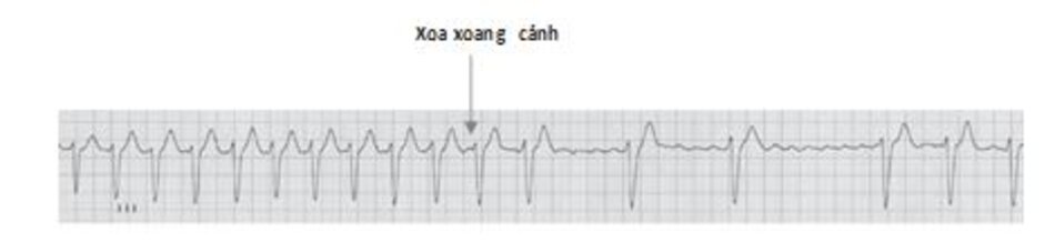 Hình 19.9: Xoa xoang cảnh. Nhịp trông có vẻ đều và có thể bị chẩn đoán nhầm với nhịp nhanh trên thất. Khi nghi ngờ chẩn đoán rung nhĩ, xoa xoang cảnh sẽ giúp ích nhằm phân biệt rung nhĩ với các loại rối loạn nhịp trên thất có phức bộ QRS hẹp khác. Xoa xoang cảnh (mũi tên) làm chậm tần số thất và làm giãn cách các khoảng RR. Điều này cho phép phát hiện đường đẳng điện lượn sóng, đặc trưng cho rung nhĩ.