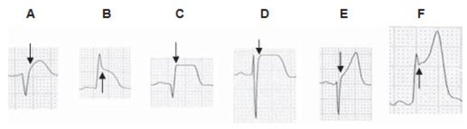 Hình 23.9: ST chênh. STEMI có thể biểu thị dưới các kiểu mẫu khác nhau ở các chuyển đạo khác nhau như ST dạng lồi, cong vòm (A, B), đi ngang hay bınh nguyên (C, D), đi xiên (E) hoặc lõm (F) dạng phi tiêu kết hợp mái vòm lòng chảo. Các mũi tên chỉ vào điểm J, tất cả đều chênh cao so với đường đẳng điện.