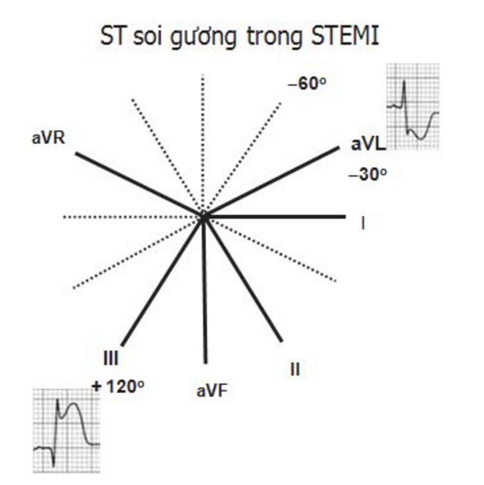 Hình 23.11: ST chênh xuống soi gương. Bởi vı ̀ trong các chuyển đạo chi thı̀ aVL là chuyển đạo gần nhất đối diện trực tiếp 